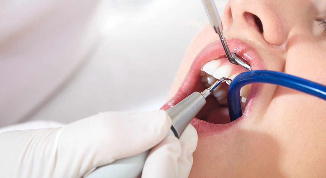 Nærbillede af en patients mund der undersøges tandlægen