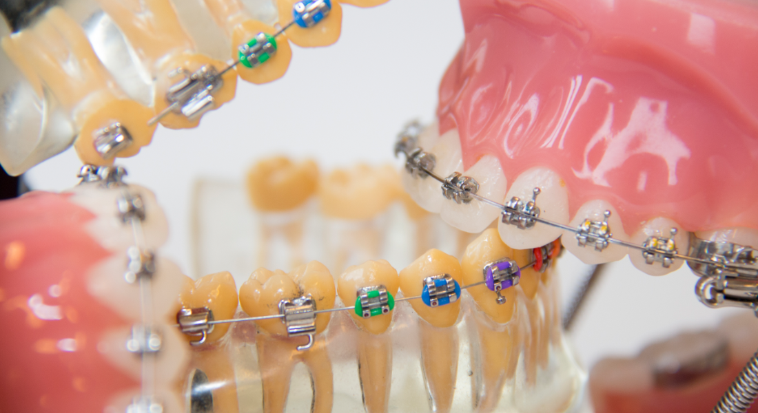 Nærbillede af tandbøjler på model