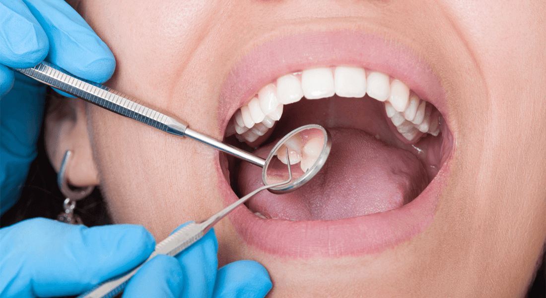 tandrensning på patient